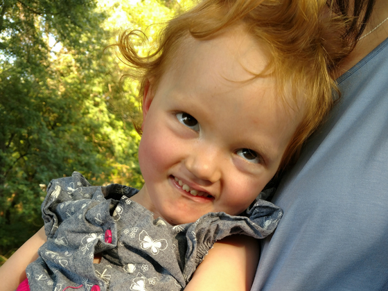 Pontocellebellar Hypoplasia Type 1B: A Rare Genetic Disorder Can’t Stop This Family