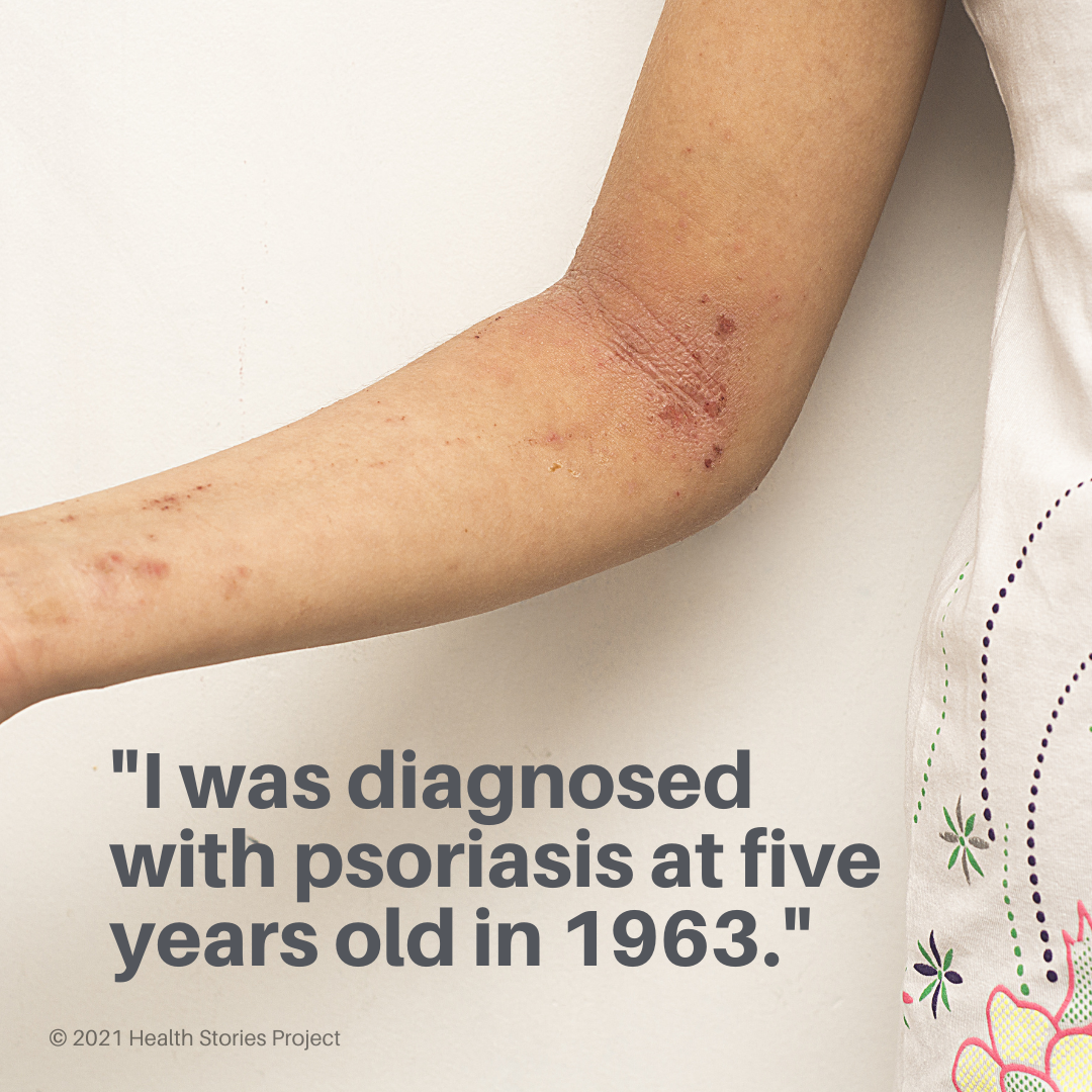 psoriasis